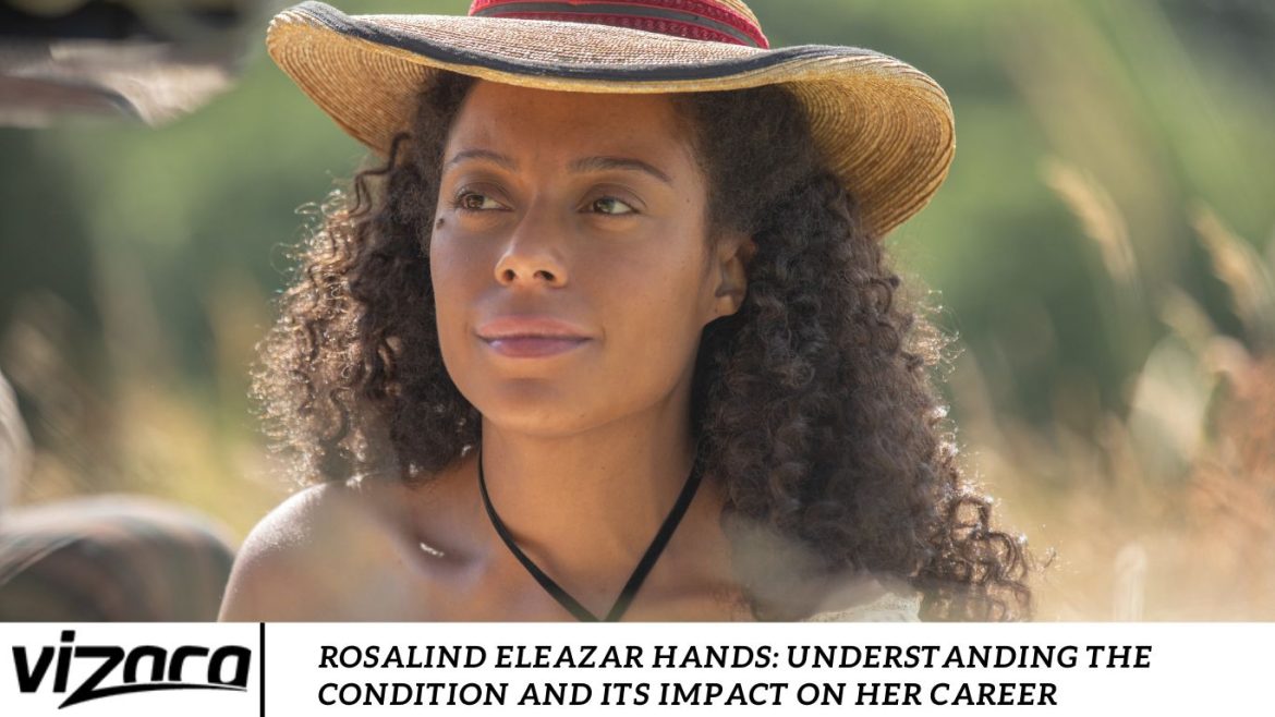 Rosalind Eleazar Hands: Understanding the Condition and Its Impact on Her Career Rosalind Eleazar Hands: Understanding the Condition and Its Impact on Her Career